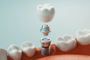 Dental Implant